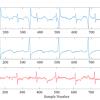 بهبود سیگنال های ECG جنین و حذف سیگنال ECG مادر در صنعت الکترونیک